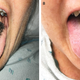 Left: The rare case of black hairy tongue. Right: The same woman four weeks after minocycline was discontinued.